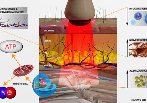 High Power Laser Therapy (HPLT)