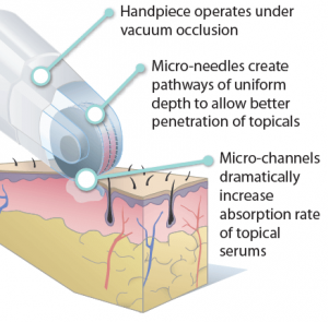 Fractional Dermal Infusion device