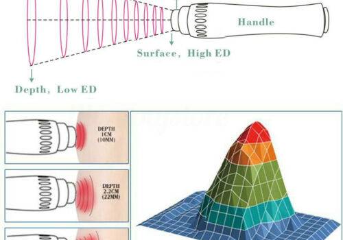 Extracorporeal Shockwave Therapy (ECSWT) · LiSWT · RPT