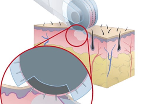 Fractional Dermal Infusion